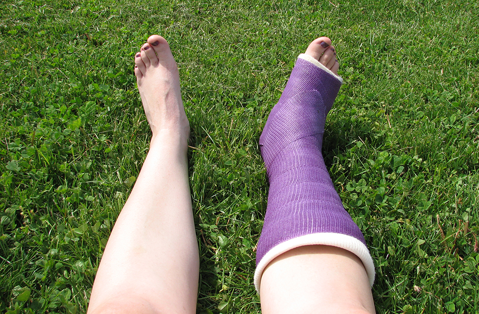 PKU Fracture image