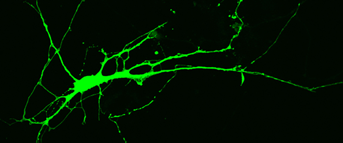 Fluorescence microscopy image of a nerve cell derived from induced pluripotent stem cells donated by an individual with Rett syndrome.